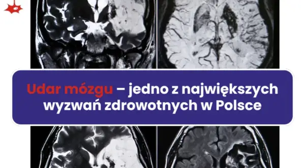 Udar mózgu: Czy umiera się? Kluczowe fakty i nadzieja na życie.