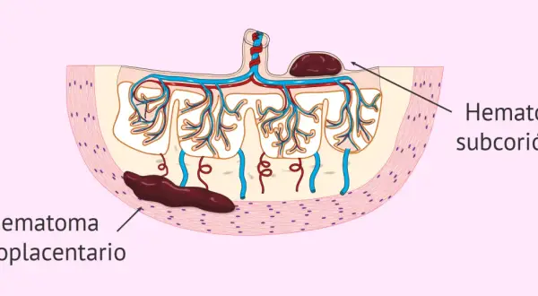 Ilustración de hematoma subcoriónico y retroplacentario, mostrando cómo se expulsa un hematoma en el embarazo.