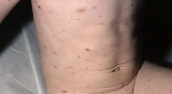 Barnets hud täckt av röda prickar, typiska för vattkoppor.