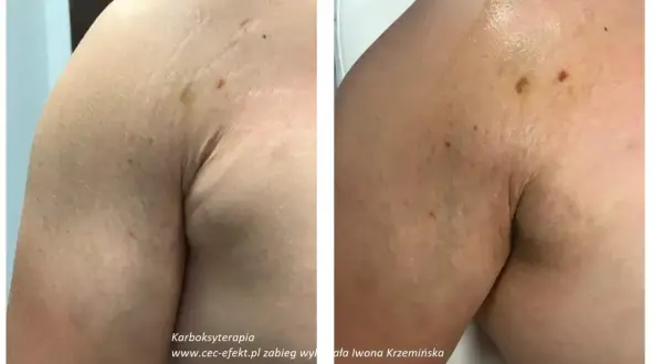 Przed i po karboksyterapii: widoczna poprawa tekstury skóry i redukcja blizn na ramieniu. Karboksyterapia efekty.