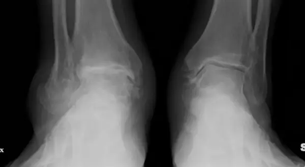 Radiografie delle caviglie mostrano segni di condropatia, con alterazioni articolari evidenti.