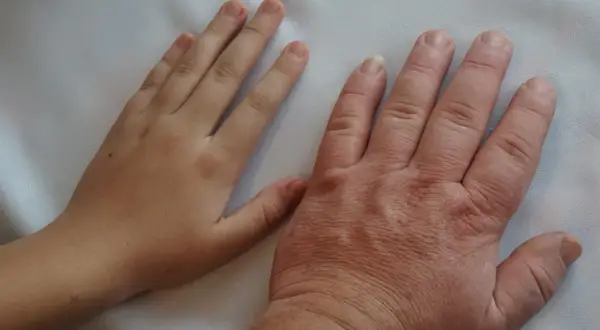 Dłoń dziecka obok dużej dłoni dorosłego, której rozmiar może sugerować akromegalię.