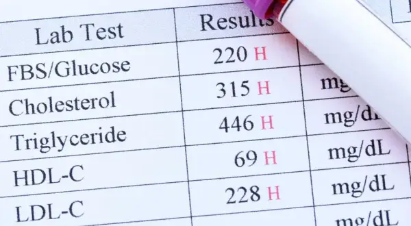 Résultats d'une prise de sang montrant des taux élevés de glucose, cholestérol et triglycérides. Une prise de sang sert à évaluer votre état de santé.