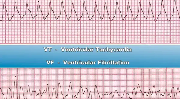 Dwa zapisy EKG: górny pokazuje rytmiczne, szybkie załamki (VT), dolny chaotyczne, nieregularne fale (migotanie komór, VF).