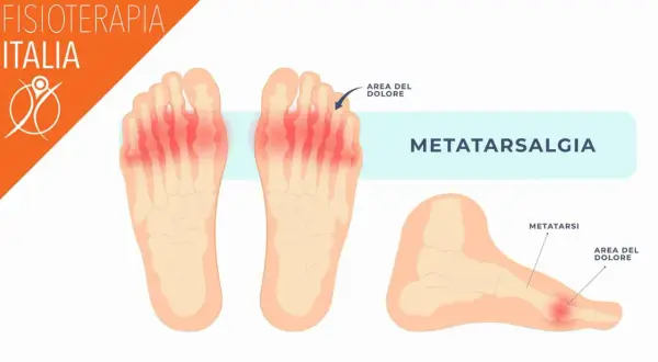 Illustrazione anatomica che mostra la metatarsalgia, un'area di dolore ai metatarsi delle dita dei piedi, evidenziata in rosso.
