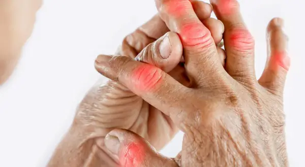 Schmerzende Fingergelenke, die auf Gicht hindeuten. Naturheilkunde kann Linderung bringen.