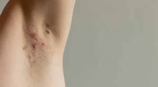 Skóra pod pachą z widocznymi zmianami, które mogą wskazywać na trądzik odwrócony.