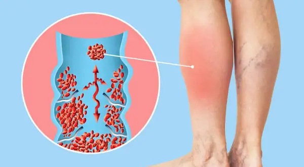 Illustration zeigt ein Bein mit Rötung und Schwellung, verbunden mit einer Veranschaulichung eines Blutgerinnsels in einer Vene. Verdacht auf Thrombose.
