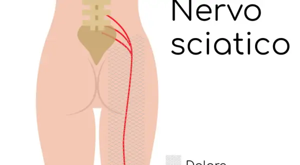 Illustrazione del nervo sciatico e del dolore al polpaccio. Rimedi per la sciatica.