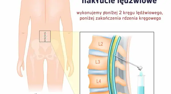 Ilustracja pokazuje punkcję kręgosłupa w odcinku lędźwiowym, poniżej zakończenia rdzenia kręgowego, z igłą wprowadzana między kręgi L3 i L4.