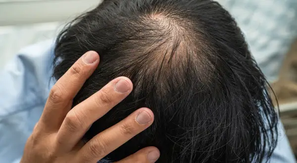 Vue rapprochée du sommet de la tête d'un homme montrant une calvitie naissante. La main d'un homme touche son cuir chevelu, peut-être en réfléchissant à la cause de sa calvitie.
