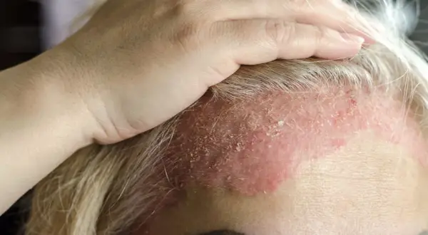 Dłoń dotyka czoła z widocznym zaczerwienieniem i łuszczącą się skórą głowy, co może wskazywać na problem dermatologiczny.