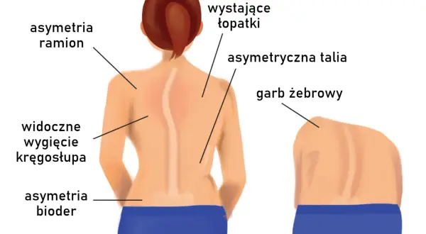 Skolioza u dorosłych objawy: Jak rozpoznać i uniknąć powikłań