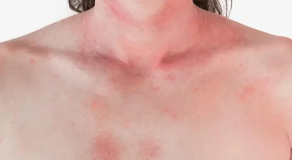 Alergia na truskawki: objawy, reakcje krzyżowe i co robić