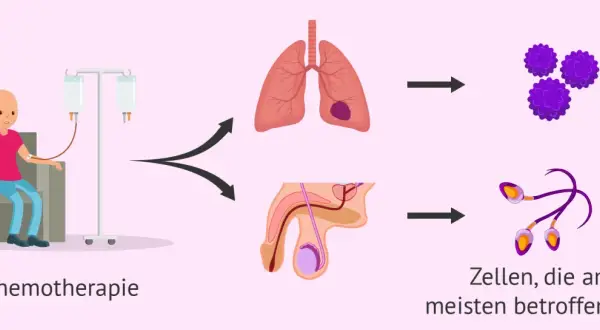 Chemotherapie kann die Fruchtbarkeit nach Chemotherapie Mann beeinträchtigen. Die Grafik zeigt Lungen- und Hodenkrebszellen, die durch die Behandlung angegriffen werden.