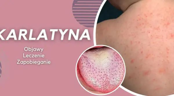 Szkarlatyna objawy u dzieci: czerwona wysypka na skórze i nalot na języku. Informacje o leczeniu i zapobieganiu.
