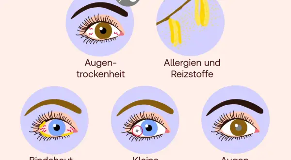 Illustrationen zeigen Ursachen für brennende Augen: Trockenheit, Allergene, Bindehautentzündung, Fremdkörper und allgemeine Augenerkrankungen.