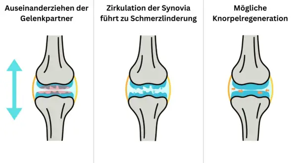 Illustration zeigt Knie-Distraktion: Gelenkpartner ziehen auseinander, Synovia-Zirkulation lindert Schmerz, Knorpel kann sich regenerieren.