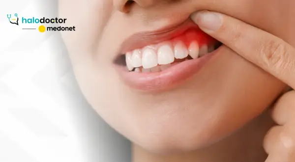 Stan zapalny dziąseł: Jak skutecznie leczyć w domu i u dentysty?