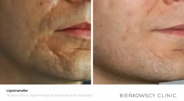 Przed i po lipofilling twarzy: widoczna poprawa blizn i przywrócenie objętości skóry.