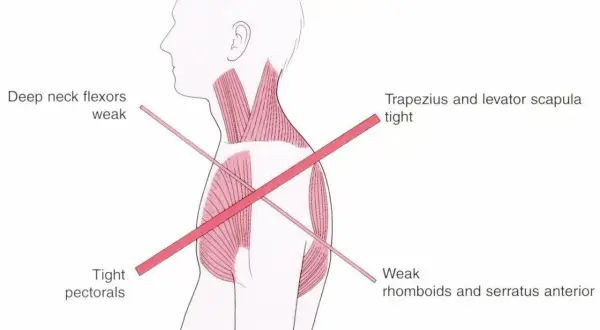 Anatomia mięśni: napięty mięsień czworoboczny, osłabione zginacze karku, napięte mięśnie piersiowe, osłabione mięśnie równoległoboczne i zębaty przedni.