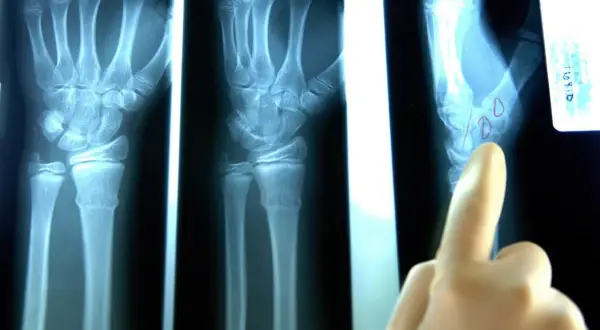 Radiografie del polso mostrano una mano con possibile distorsione al polso. Un dito indica un'area di interesse.