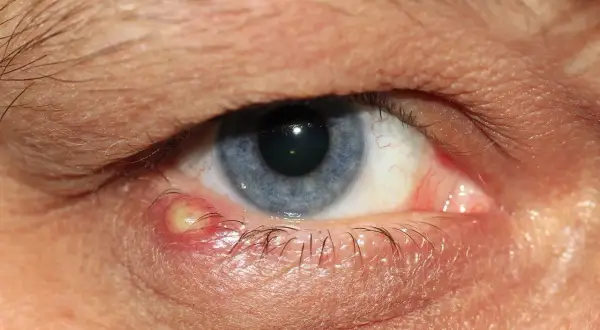 Ein entzündeter Gerstenkorn am Augenlid, der Juckreiz verursacht. Das Auge ist rot und geschwollen.