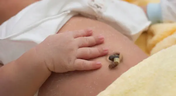Babybauch mit abgefallener Nabelschnur und leichter Kruste. Ein kleines Babyhändchen liegt daneben.