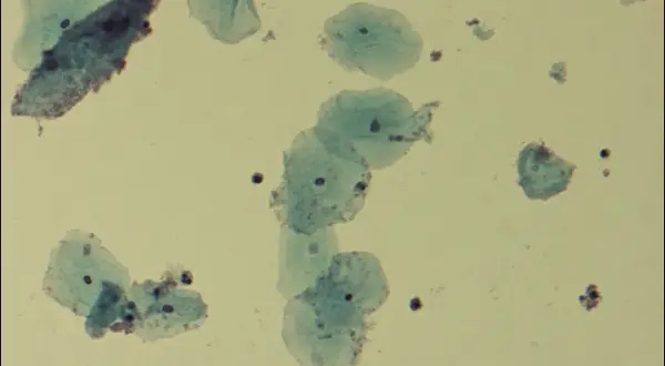 Cellules épithéliales et quelques bactéries, possiblement liées à la gardnerella transmission par l'homme.