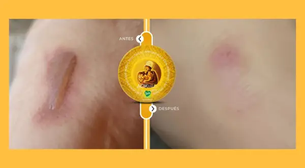 Antes y después de usar la grasa de shea: una cicatriz mejora visiblemente.