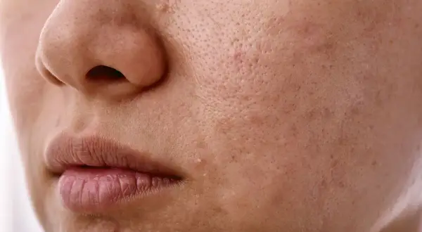 Skóra z widocznymi porami i śladami po niedoskonałościach, sugerującymi nadmierne wydzielanie sebum.