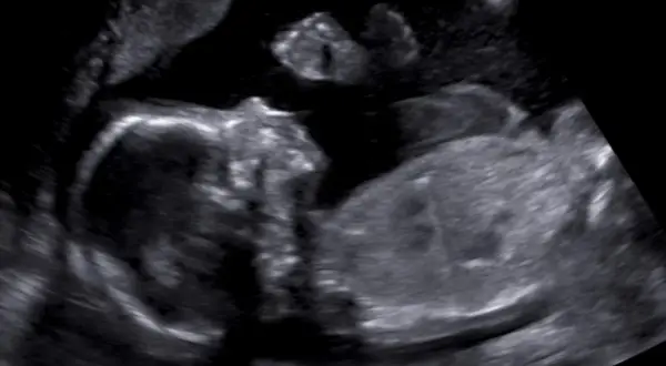 Ultraljudsbild visar två foster. Tidiga symptom på gravid med tvillingar kan vara mer uttalade.