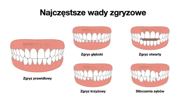 Ilustracja pokazuje różne wady zgryzu: zgryz głęboki, otwarty, krzyżowy i stłoczenia zębów, obok prawidłowego zgryzu.