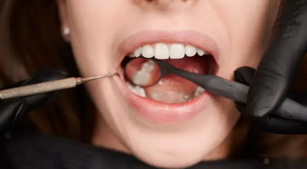 Usta kobiety otwarte, dentysta w czarnej rękawiczce bada ząb mądrości lusterkiem i narzędziem.