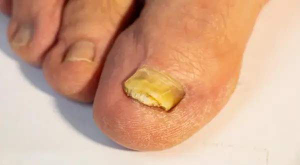 Primo piano di un alluce con unghia gialla e spessa, segno di un'infezione fungina.