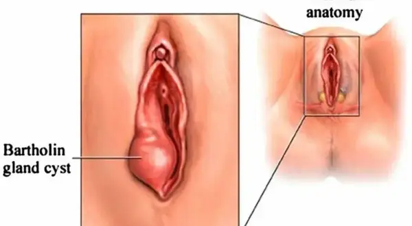 Ilustracja pokazuje ropień gruczołu Bartholina, powiększoną torbiel po lewej stronie, w porównaniu do normalnej anatomii po prawej.