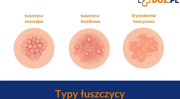Ilustracja pokazuje trzy typy łuszczycy: zwyczajną, krostkową i erytrodermię łuszczycową. Ważne, by rozpoznać łuszczycę u dzieci.