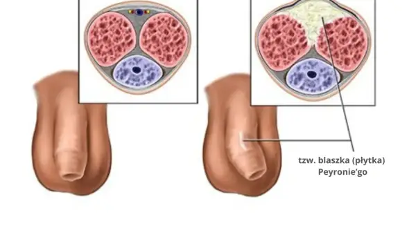 Przekrój prącia z widocznym twardym guzem pod skórą, tzw. blaszką Peyroniego, powodującym deformację.