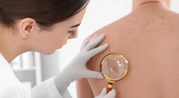 Dermatolog bada plecy pacjenta, skupiając się na jednym, twardym guzkem pod skórą, używając lupy.