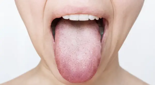 Lingua arrossata e con papille evidenti, possibile segno di candidosi orale.