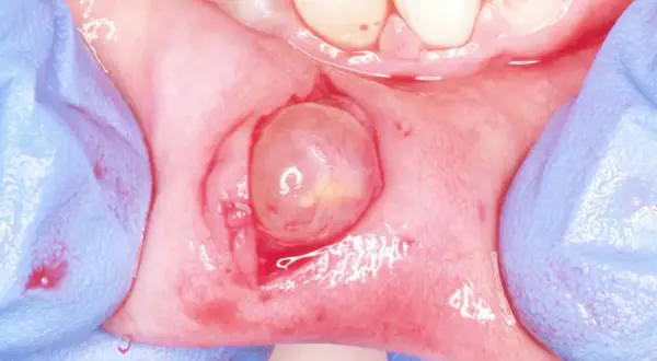 Gloved hands retracting tissue to reveal a translucent, rounded lesion on the gum, likely a fibroma orale.