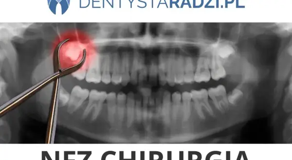 Usuwanie zęba na NFZ w Łodzi: Adresy, zasady, co refunduje?