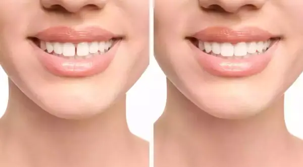 Prima e dopo: il diastema, uno spazio tra i denti, viene corretto per un sorriso perfetto.