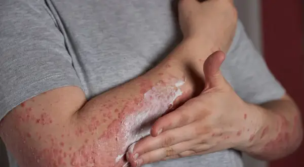 Person cremt Arm mit Neurodermitis ein. Die Haut ist gerötet und schuppig. Die richtige Kleidung bei Neurodermitis ist wichtig.