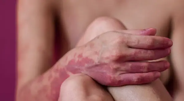 Skóra ręki i ramienia pokryta czerwonymi, nieregularnymi plamami, sugerującymi zakażenie lub reakcję alergiczną.