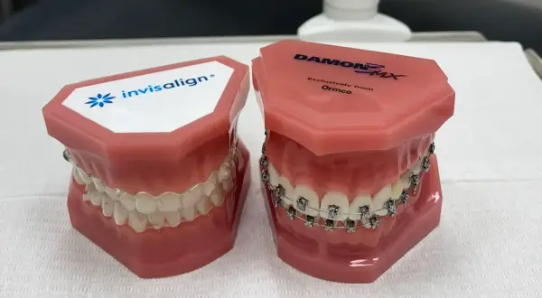 Modele szczęk prezentujące tradycyjny aparat ortodontyczny i dyskretny aparat invisalign.