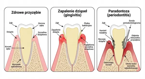 Ilustracja pokazuje postęp paradontozy: zdrowe dziąsła, zapalenie dziąseł i paradontozę. Domowe leczenie paradontozy jest kluczowe.