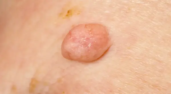 Zmiana skórna, widoczna na zdjęciu, może być jednym z objawów wirusa HPV.