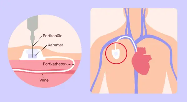 Schema zeigt ein medizinisches Portsystem: eine Nadel (Portkanüle) in der Kammer, verbunden mit einem Katheter in einer Vene. Das Port-System liegt nahe dem Herzen.