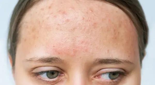 Alergia na mleko u dorosłych: objawy skórne, diagnoza i leczenie